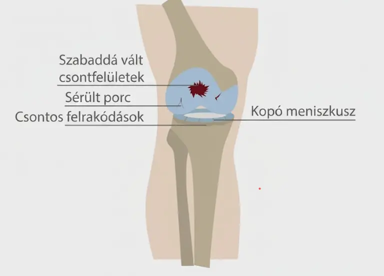 Térd osteoarthritis (porckopás) állapotát bemutató orvosi diagram magyar feliratokkal. A képen láthatók a szabaddá vált csontfelületek, a sérült porc, a csontos felrakódások és a kopó meniszkusz